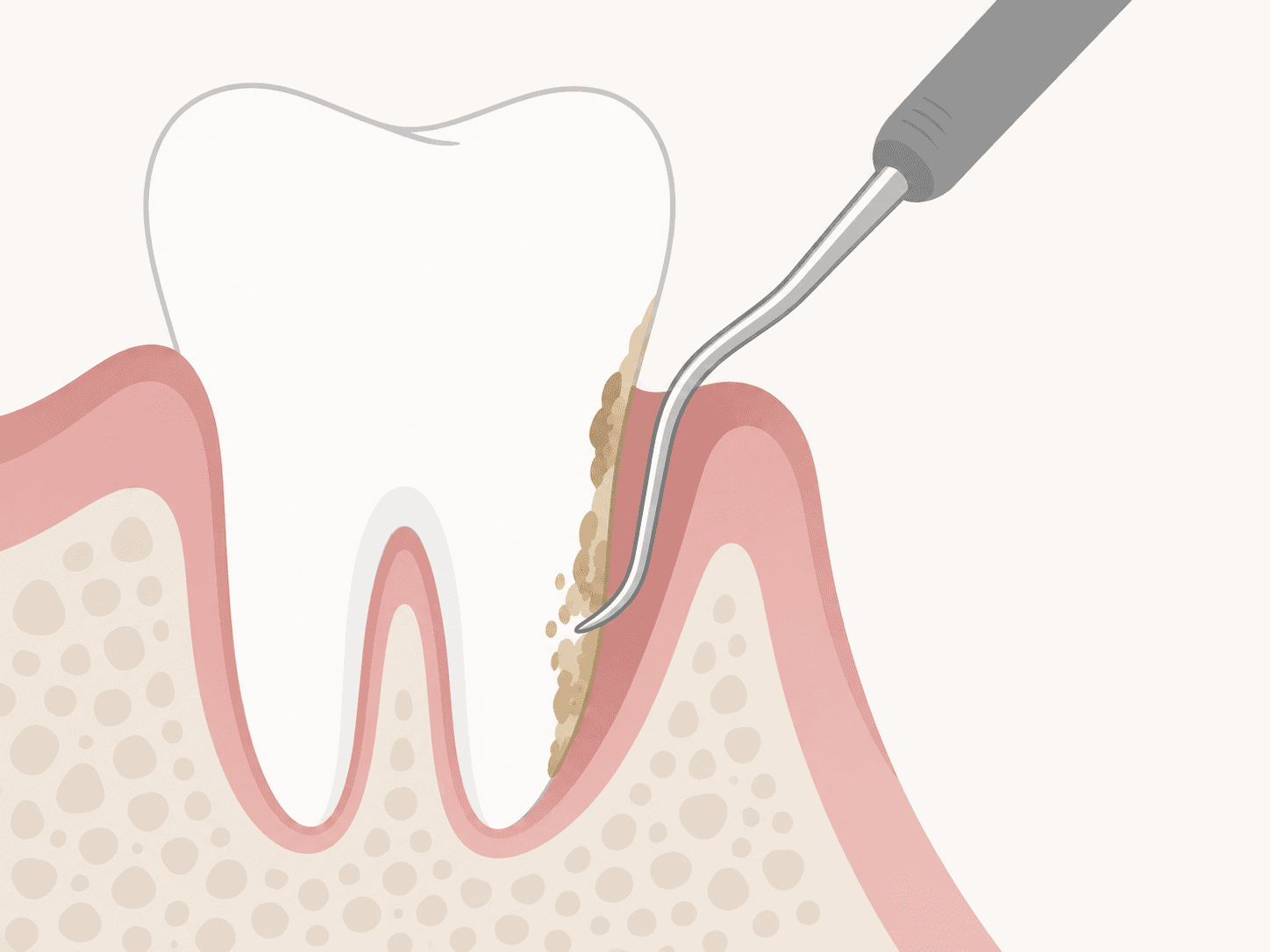 치근활택 (SRP) — 치근활택(SRP) 진료 일러스트 — 치주낭 깊은 곳의 치석을 큐렛으로 긁어내는 단면 모습