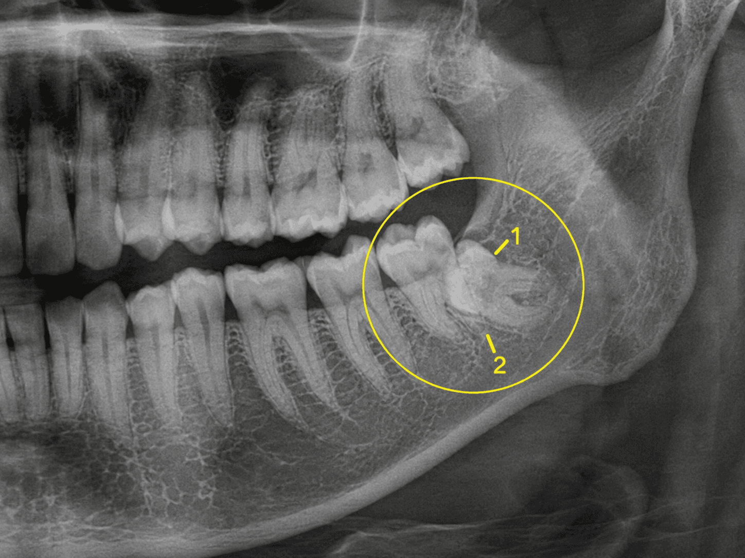 수직 매복 파노라마 X-ray