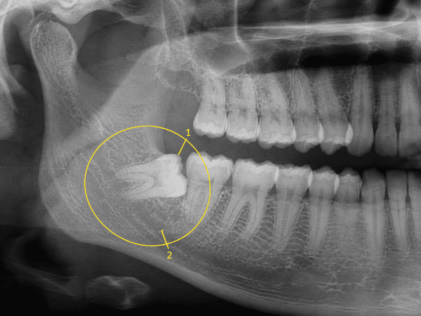 근심 경사 매복 파노라마 X-ray