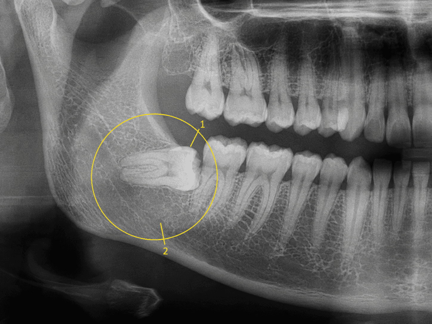 수평 매복 파노라마 X-ray