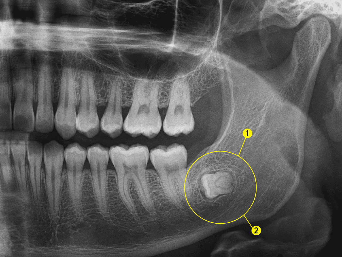 완전 매복 파노라마 X-ray